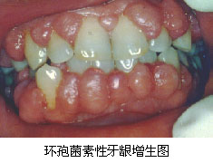 药物性牙龈增生