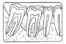 单纯性牙周炎