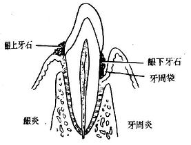 单纯性牙周炎