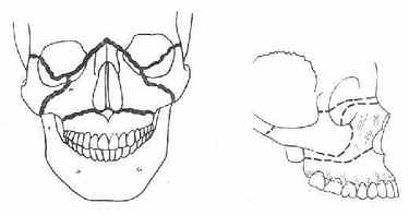 颌骨骨折