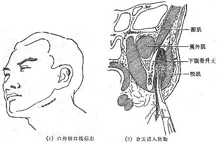 咬肌间隙感染