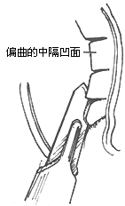 鼻中隔偏曲