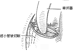 上颌窦恶性肿瘤