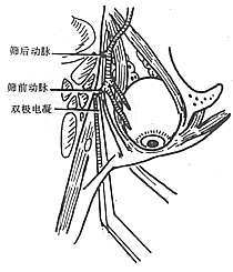 上颌窦恶性肿瘤