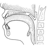 咽部瘢痕狭窄