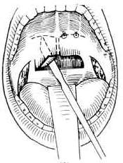 咽部瘢痕狭窄
