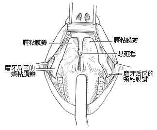 咽部瘢痕狭窄