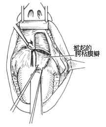 咽部瘢痕狭窄