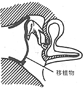 慢性化脓性中耳炎