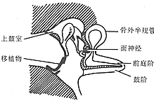 慢性化脓性中耳炎