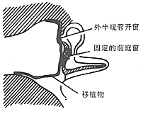 慢性化脓性中耳炎