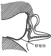 慢性化脓性中耳炎