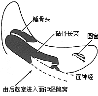 慢性化脓性中耳炎