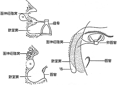 慢性化脓性中耳炎