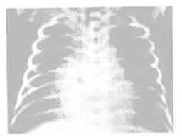 新生儿肺透明膜病