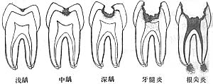 龋齿