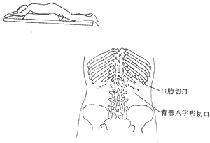 皮质醇增多症