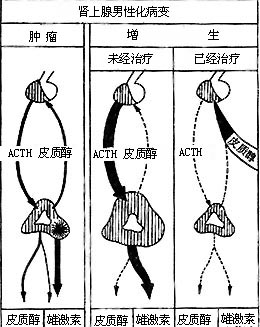 肾上腺性征异常症