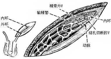 精索静脉曲张