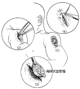 毛细血管瘤和海绵状血管瘤切除术图片