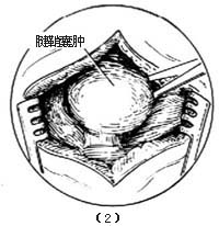 腱鞘囊肿切除术图片