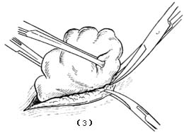 脂肪瘤切除术图片