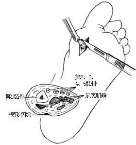 鸡眼切除术图片