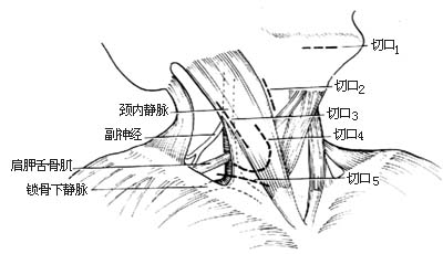 颈部淋巴结切除术图片