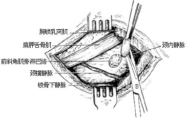 颈部淋巴结切除术图片