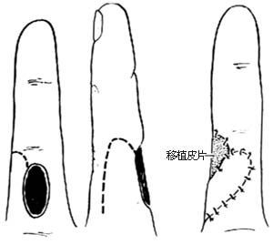 手指皮肤缺损修复术图片