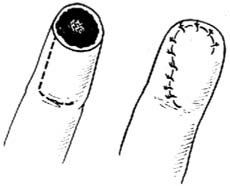 手指外伤性截指修复术图片