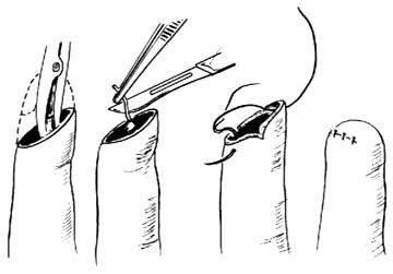 手指外伤性截指修复术图片