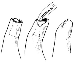 手指外伤性截指修复术图片