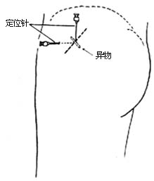 软组织金属异物取出术图片