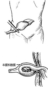 脐疝修复术图片