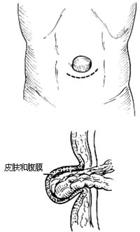 脐疝修复术图片