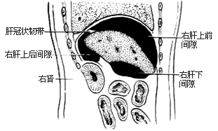 膈下脓肿切开引流术图片