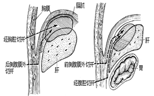 膈下脓肿切开引流术图片