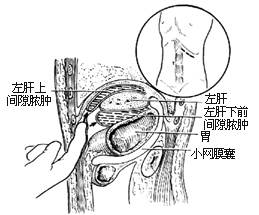 前侧腹膜外膈下脓肿切开引流术图片