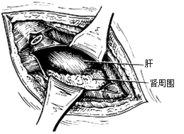 后侧腹膜外膈下脓肿切开引流术图片