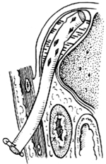后侧腹膜外膈下脓肿切开引流术图片