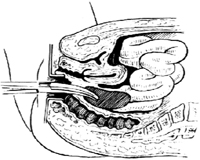 经直肠盆腔脓肿切开引流术图片