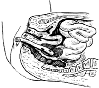 经直肠盆腔脓肿切开引流术图片