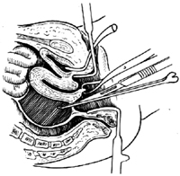 经阴道盆腔脓肿切开引流术图片