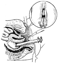 经阴道盆腔脓肿切开引流术图片