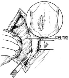 腹壁切口疝修复术图片