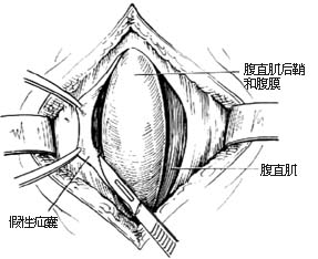腹壁切口疝修复术图片
