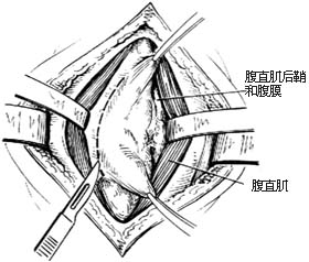 腹壁切口疝修复术图片