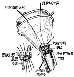 一般腹股沟斜疝修复术图片