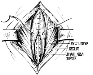 腹壁切口疝修复术图片